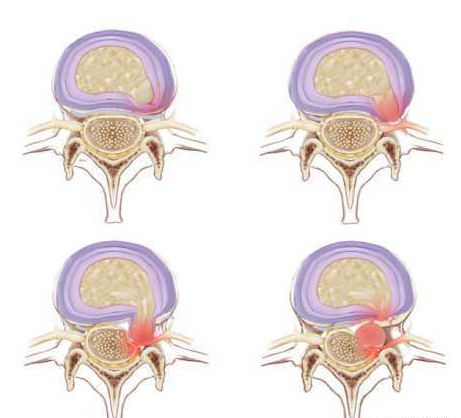 一分鐘了解腰椎間盤突出 治療不再難 