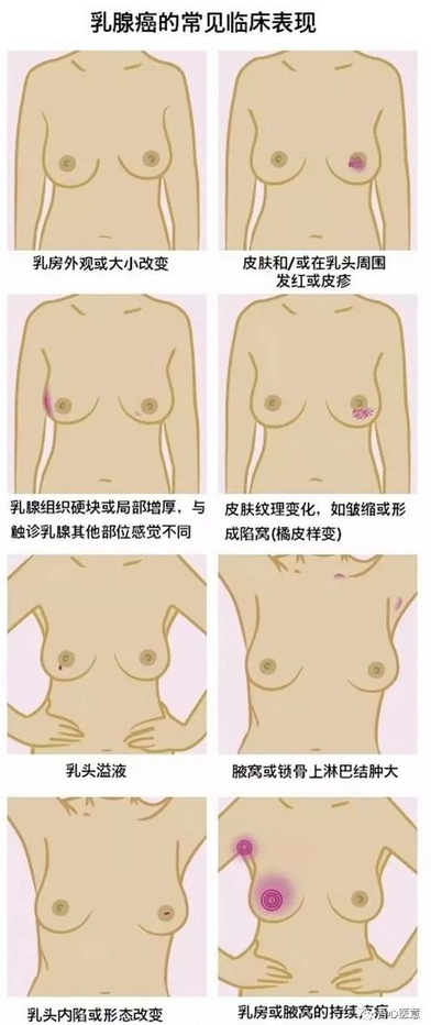 乳腺癌發(fā)生轉(zhuǎn)移了，手術(shù)還有意義嗎？